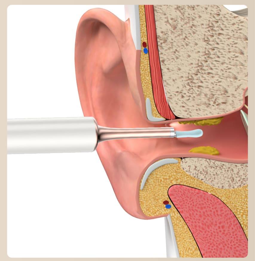 сродак для выдалення вушной серы чыстка вуха